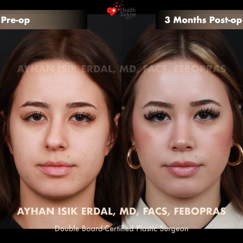 Rhinoplasty Turkey before and after — female patient frontal view, 3 months post-op