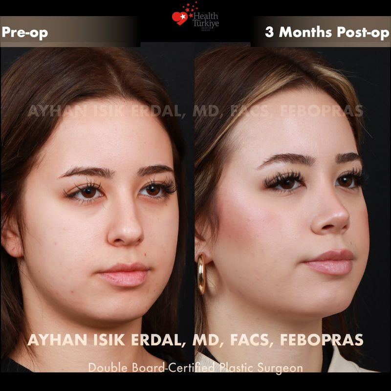 Rhinoplasty Turkey before and after — female patient oblique view, 3 months post-op