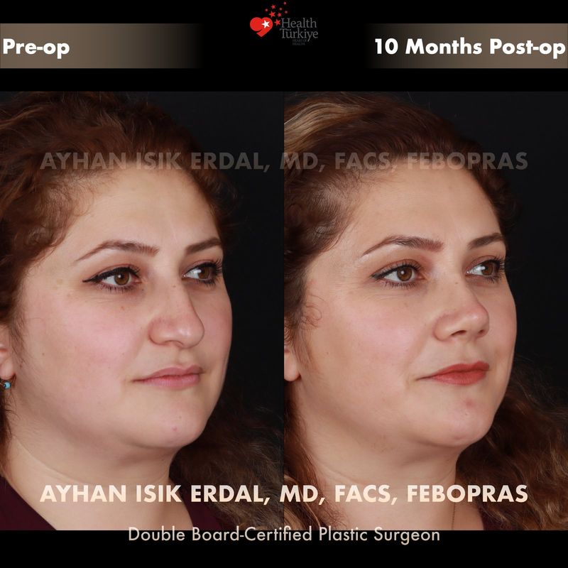 Closed technique rhinoplasty result — female patient oblique view