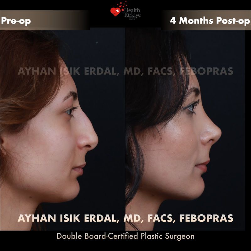 Closed rhinoplasty before and after — female patient profile view, 4 months post-op