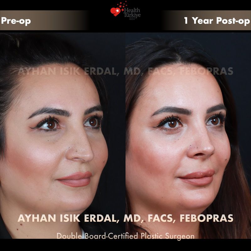 No scar rhinoplasty before and after — female patient oblique view