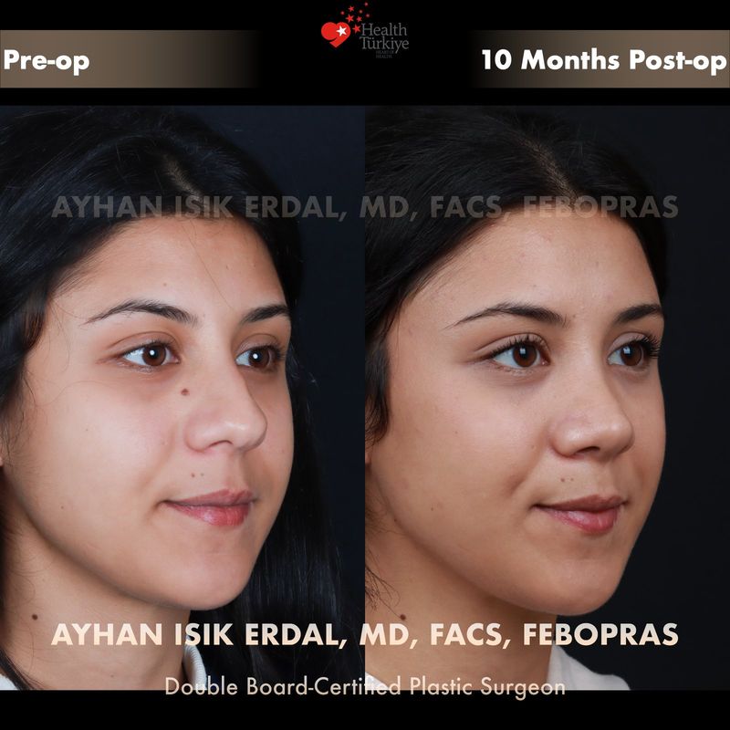 Male closed rhinoplasty before and after — oblique view, 4 months post-op