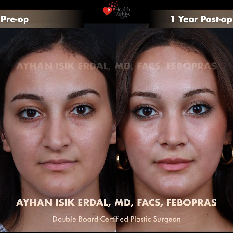 Closed rhinoplasty 1 year result — female patient frontal view
