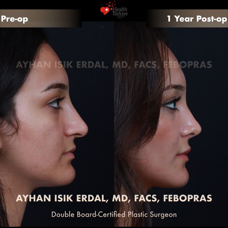 Closed rhinoplasty 1 year result — female patient profile view