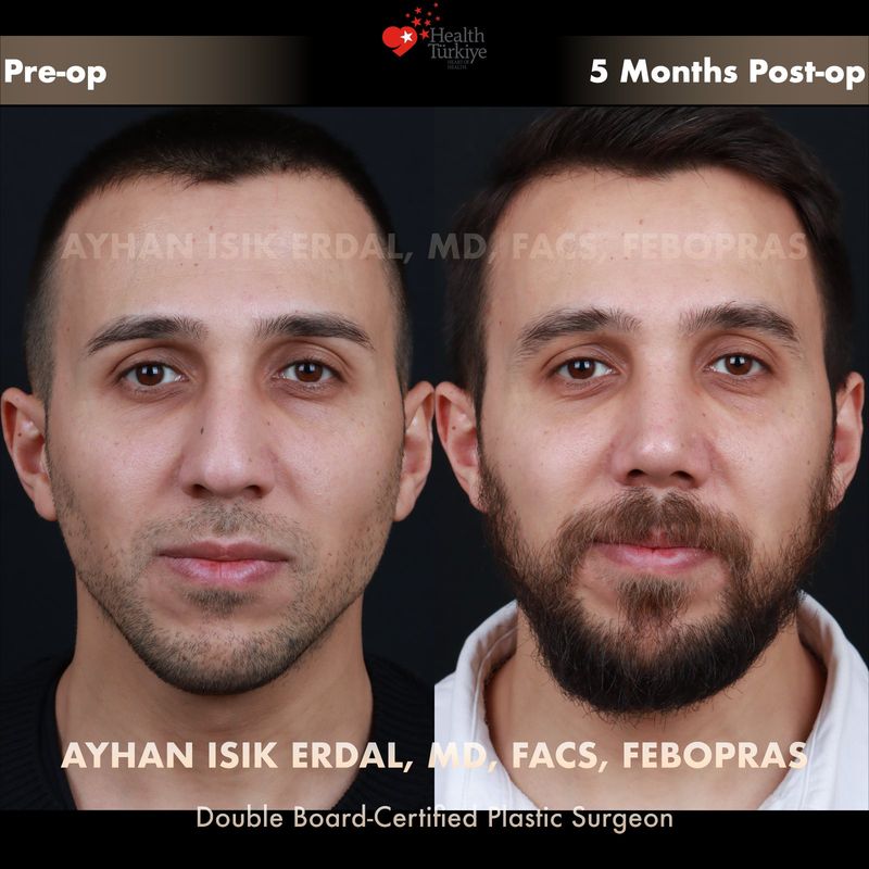 Male rhinoplasty Istanbul — frontal view before after, 5 months post-op