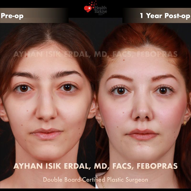Rhinoplasty before after Istanbul — female patient frontal view, 1 year post-op