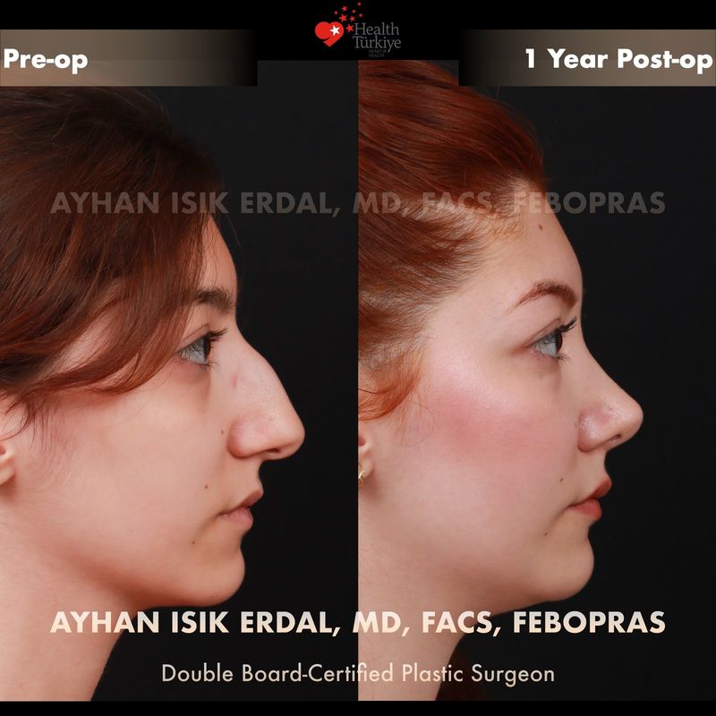 Rhinoplasty before after Istanbul — female patient profile view, 1 year post-op